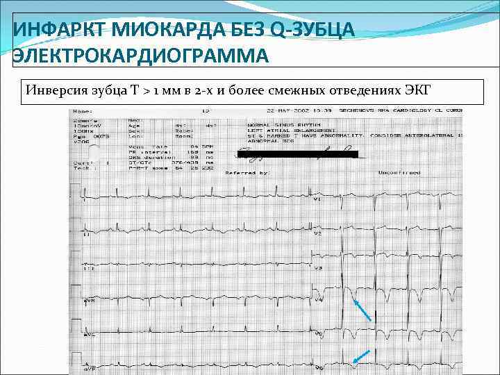 ИНФАРКТ МИОКАРДА БЕЗ Q-ЗУБЦА ЭЛЕКТРОКАРДИОГРАММА Инверсия зубца Т > 1 мм в 2 -х