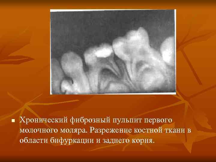 n Хронический фиброзный пульпит первого молочного моляра. Разрежение костной ткани в области бифуркации n Хронический фиброзный пульпит первого молочного моляра. Разрежение костной ткани в области бифуркации