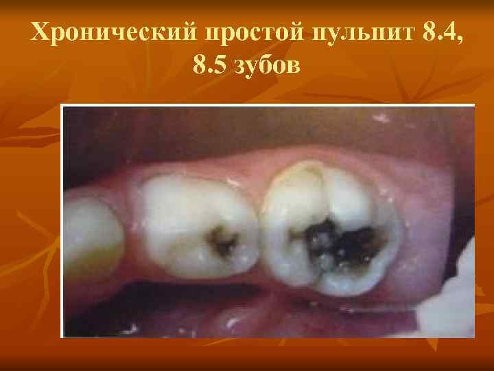 Хронический простой пульпит 8. 4, 8. 5 зубов Хронический простой пульпит 8. 4, 8. 5 зубов