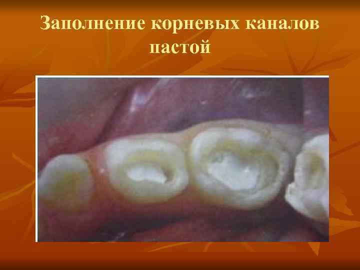 Заполнение корневых каналов пастой Заполнение корневых каналов пастой