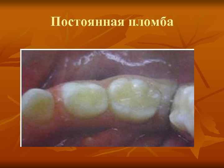 Постоянная пломба Постоянная пломба