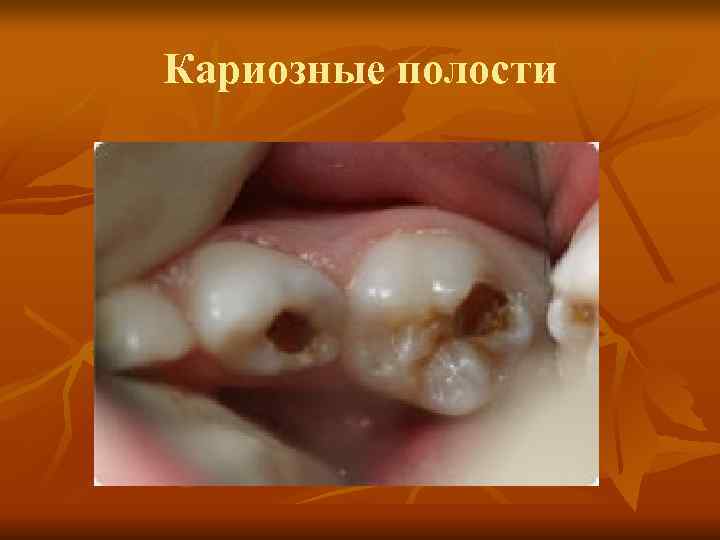Кариозные полости Кариозные полости