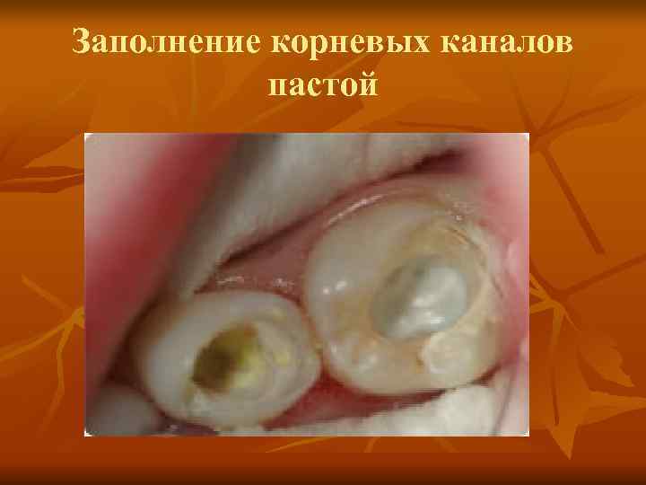 Заполнение корневых каналов пастой Заполнение корневых каналов пастой