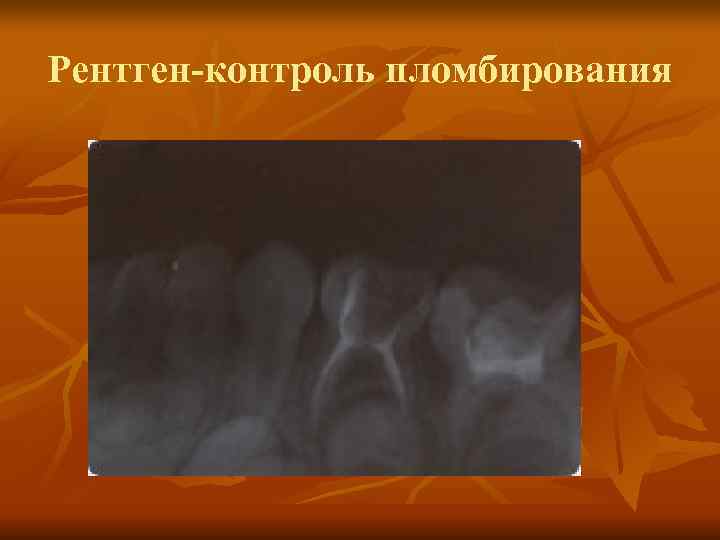 Рентген-контроль пломбирования Рентген-контроль пломбирования
