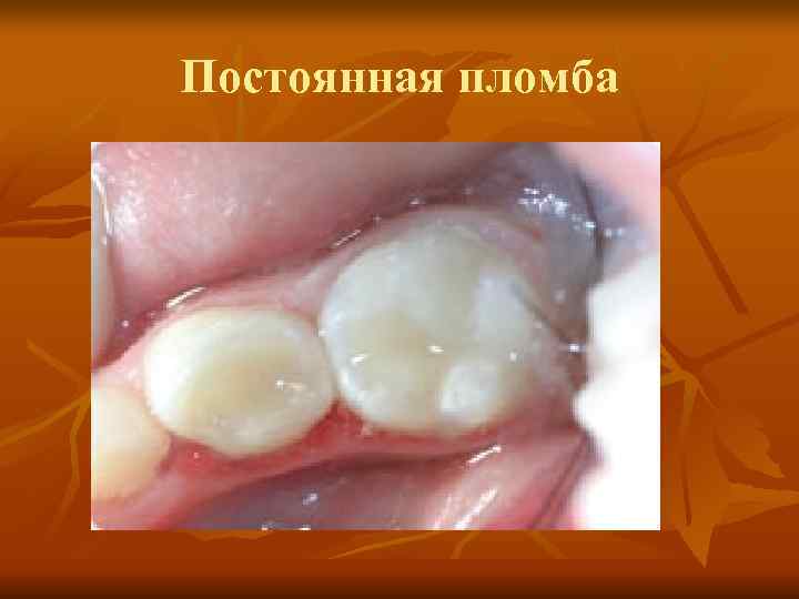 Постоянная пломба Постоянная пломба