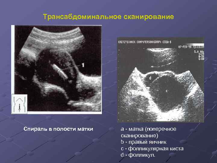  Трансабдоминальное сканирование   Спираль в полости матки  а - матка (поперечное