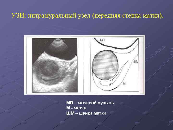 УЗИ: интрамуральный узел (передняя стенка матки).    МП – мочевой пузырь 