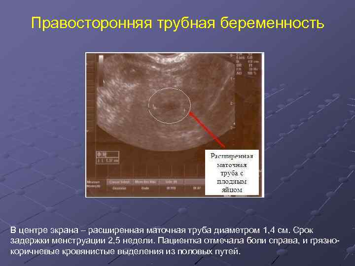   Правосторонняя трубная беременность В центре экрана – расширенная маточная труба диаметром 1,