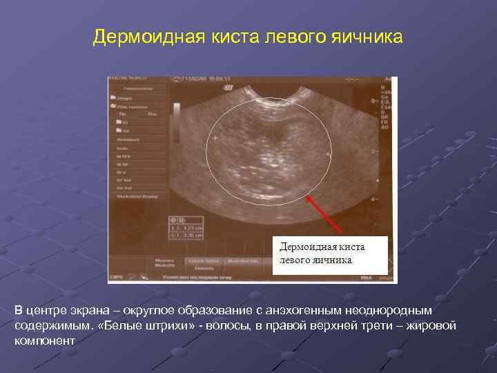   Дермоидная киста левого яичника В центре экрана – округлое образование с анэхогенным