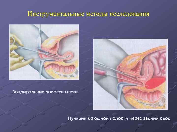  Инструментальные методы исследования Зондирование полости матки      Пункция брюшной