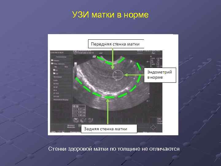 Сколько должен быть эндометрий в норме. Ультразвуковое исследование трансвагинальное норма. Передняя и задняя стенка матки на УЗИ. УЗИ матки норма.
