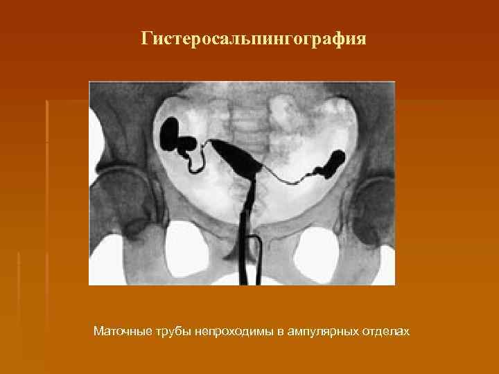  Гистеросальпингография Маточные трубы непроходимы в ампулярных отделах 