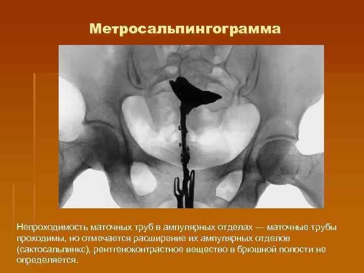     Метросальпингограмма Непроходимость маточных труб в ампулярных отделах — маточные трубы