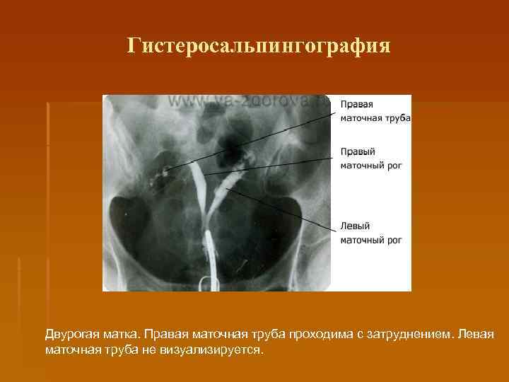 Где находятся фаллопиевы трубы у женщин фото