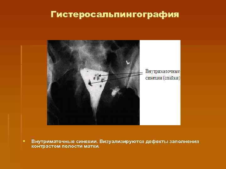    Гистеросальпингография §  Внутриматочные синехии. Визуализируются дефекты заполнения контрастом полости матки.