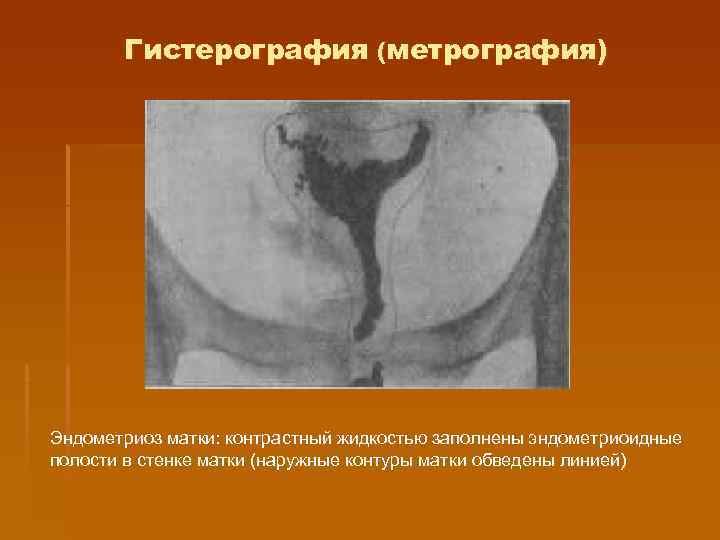   Гистерография (метрография) Эндометриоз матки: контрастный жидкостью заполнены эндометриоидные полости в стенке матки