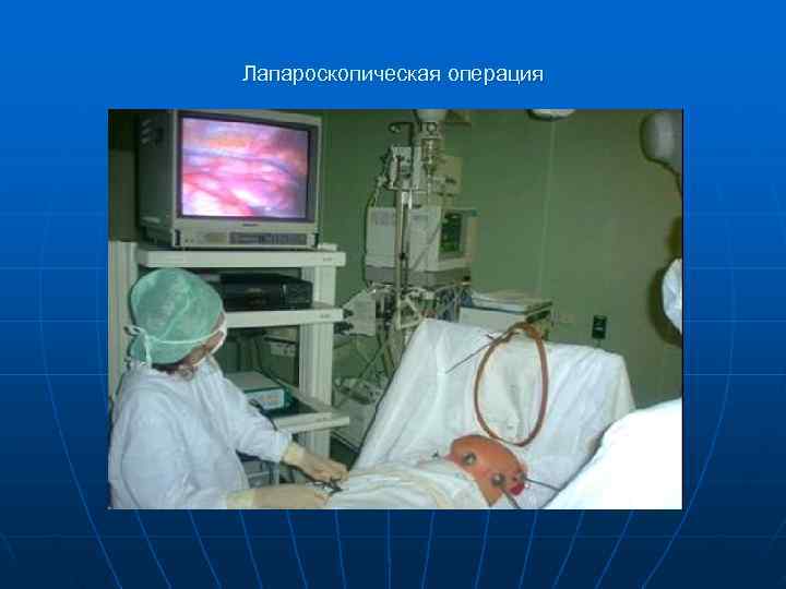 Лапароскопическая операция 