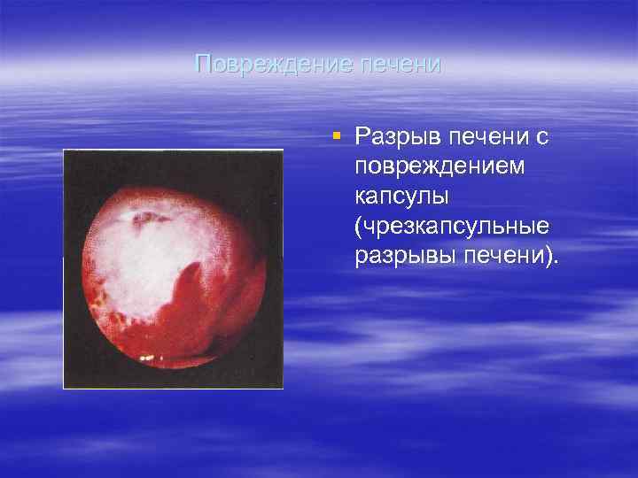 Повреждение печени  § Разрыв печени с  повреждением  капсулы  (чрезкапсульные 