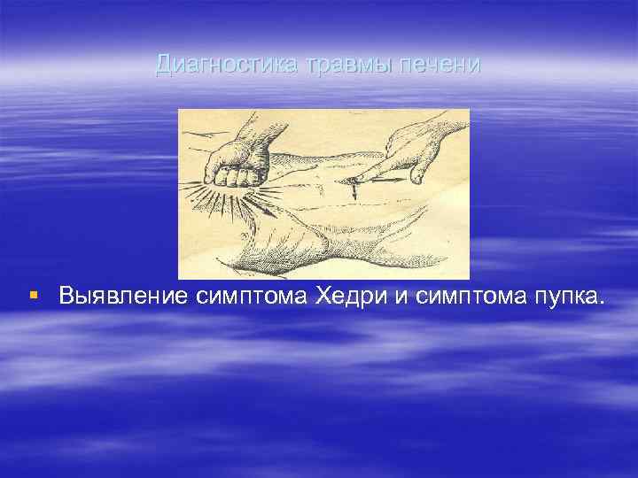    Диагностика травмы печени § Выявление симптома Хедри и симптома пупка. 