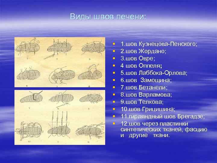 Виды швов печени:   §  1. шов Кузнецова Пенского;  § 