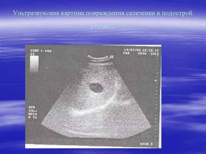 Ультразвуковая картина повреждения селезенки в подострой     стадии. 