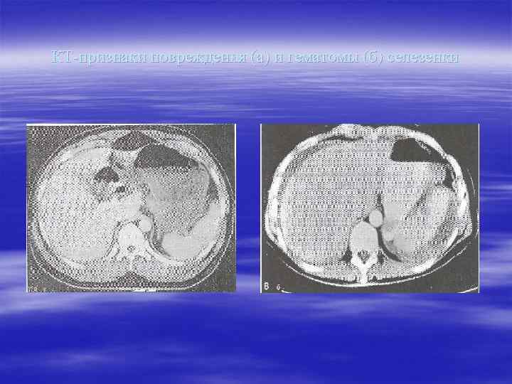 КТ-признаки повреждения (а) и гематомы (б) селезенки 