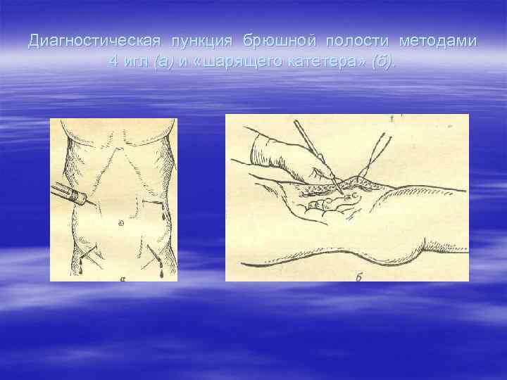 Диагностическая пункция брюшной полости методами   4 игл (а) и «шарящего катетера» (б).