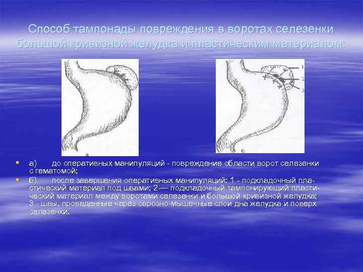  Способ тампонады повреждения в воротах селезенки большой кривизной желудка и пластическим материалом: §