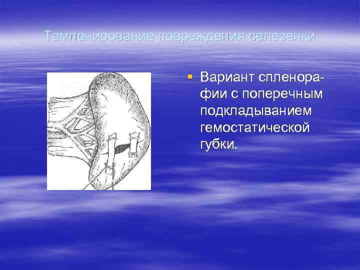 Тампонирование повреждения селезенки    § Вариант спленора     фии