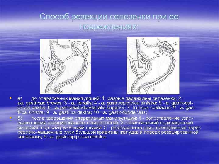   Способ резекции селезенки при ее    повреждениях: § 