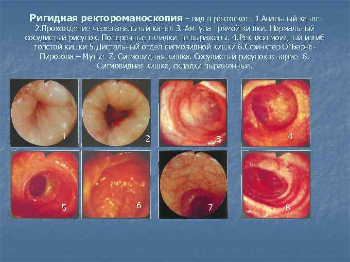  Ригидная ректороманоскопия – вид в ректоскоп   1. Анальный канал  2.