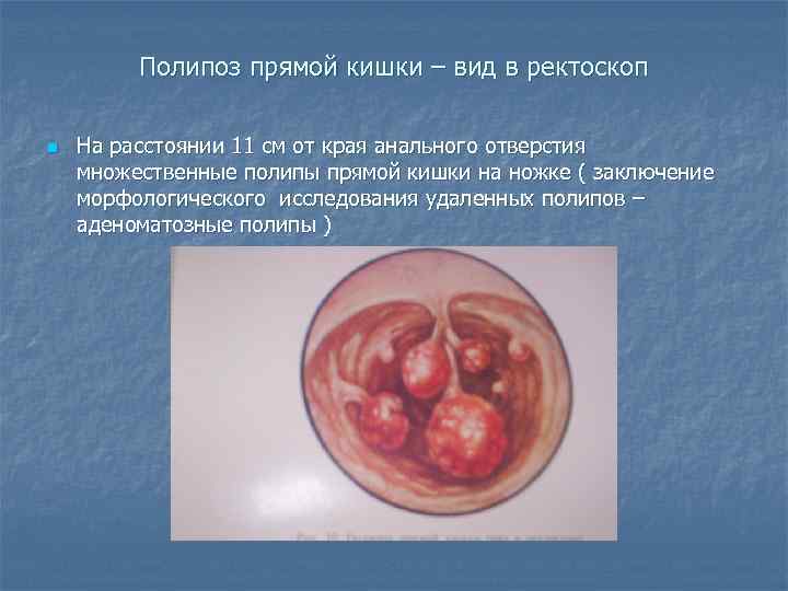    Полипоз прямой кишки – вид в ректоскоп n  На расстоянии