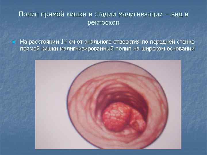   Полип прямой кишки в стадии малигнизации – вид в   