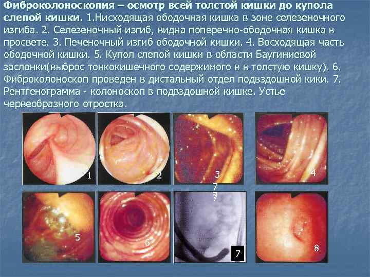 Фиброколоноскопия – осмотр всей толстой кишки до купола слепой кишки. 1. Нисходящая ободочная кишка