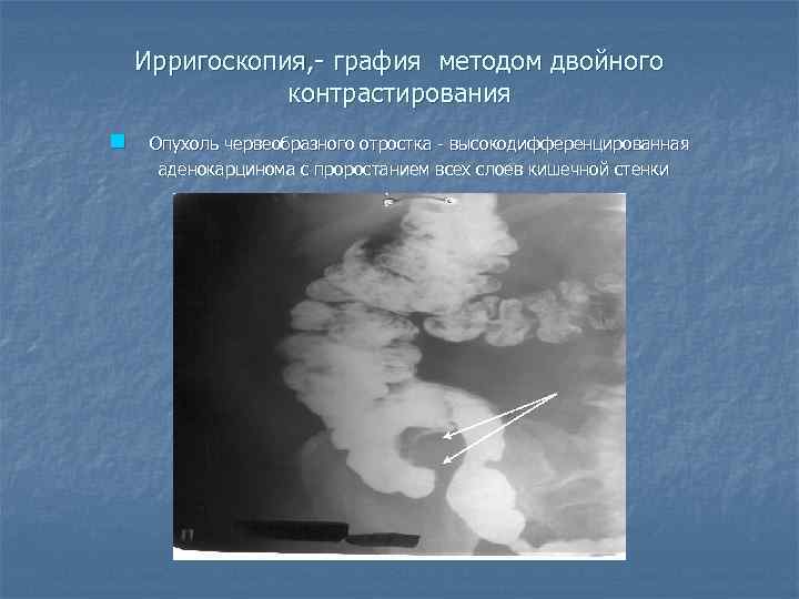   Ирригоскопия, - графия методом двойного    контрастирования n  Опухоль