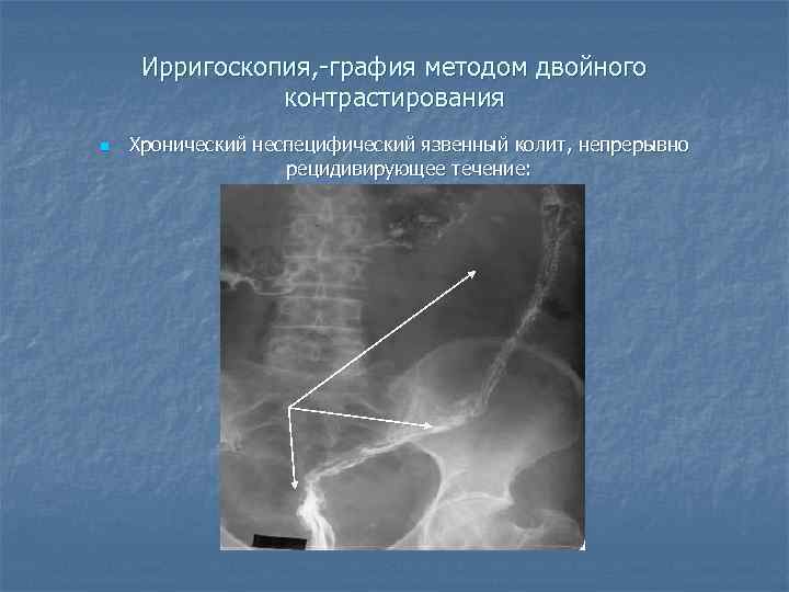  Ирригоскопия, -графия методом двойного    контрастирования n  Хронический неспецифический язвенный