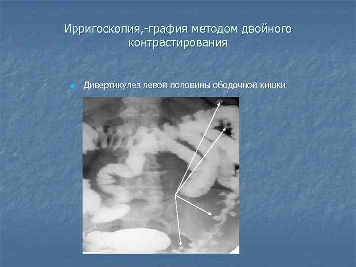 Ирригоскопия, -графия методом двойного  контрастирования  n  Дивертикулез левой половины ободочной кишки