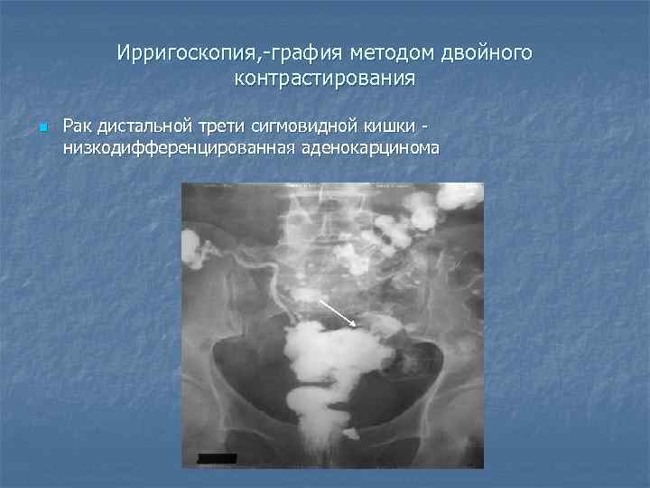    Ирригоскопия, -графия методом двойного    контрастирования n  Рак