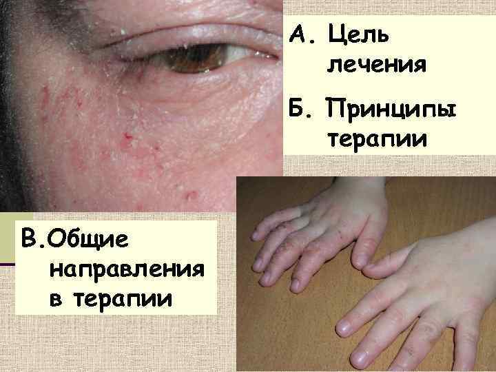     А. Цель    лечения   Б. Принципы