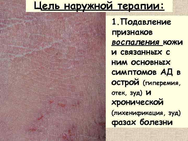 Цель наружной терапии:    1. Подавление   признаков   воспаления