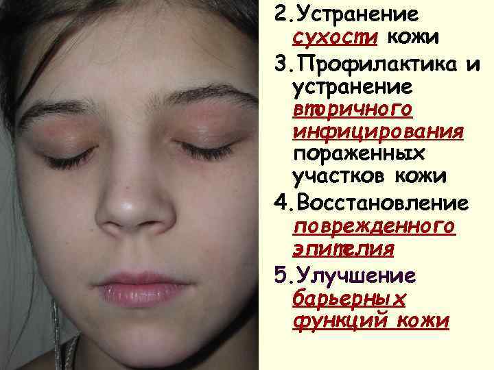 2. Устранение  сухости кожи 3. Профилактика и  устранение  вторичного  инфицирования