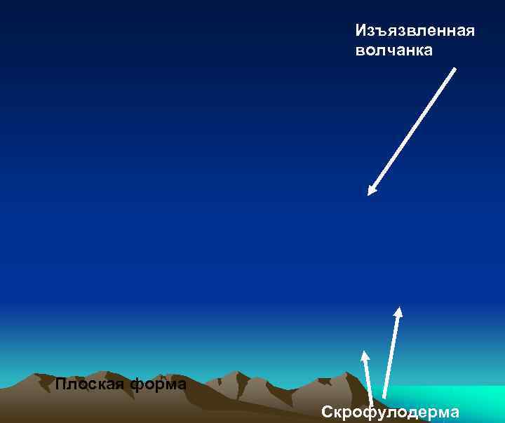     Изъязвленная    волчанка Плоская форма   Скрофулодерма