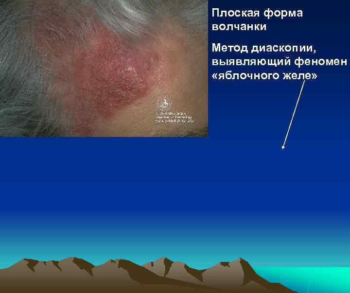 Плоская форма волчанки Метод диаскопии, выявляющий феномен «яблочного желе» 