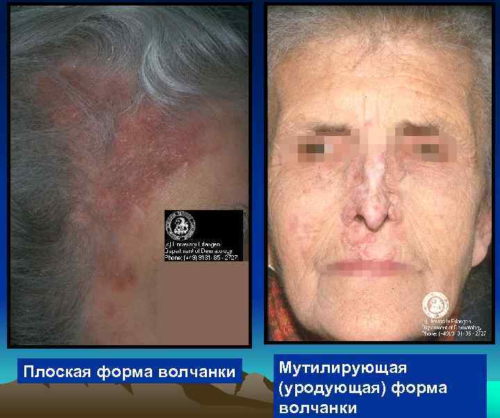 Плоская форма волчанки  Мутилирующая     (уродующая) форма   