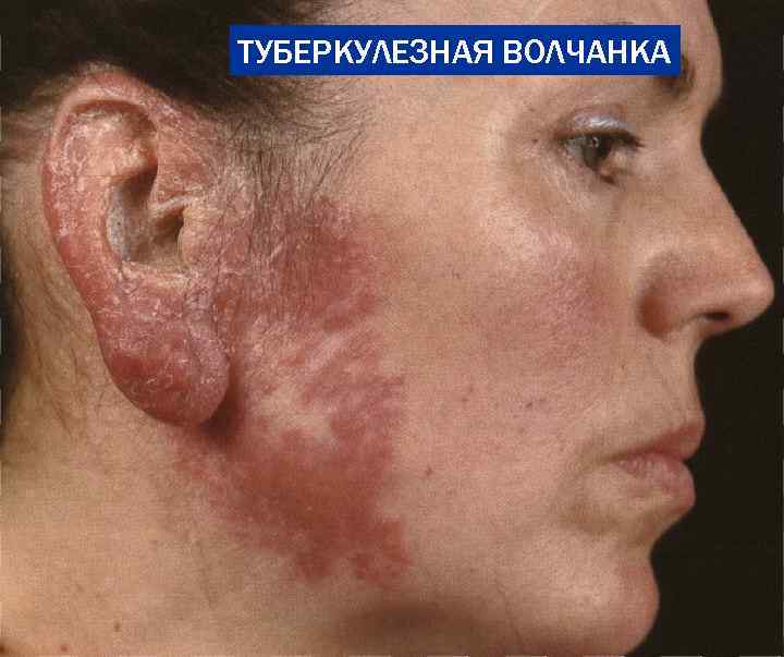 ТУБЕРКУЛЕЗНАЯ ВОЛЧАНКА 
