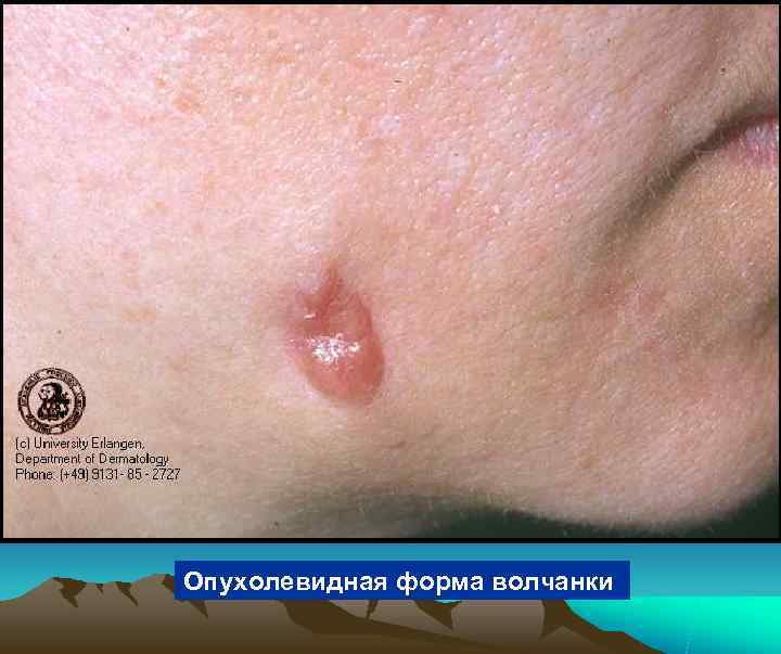 Опухолевидная форма волчанки 