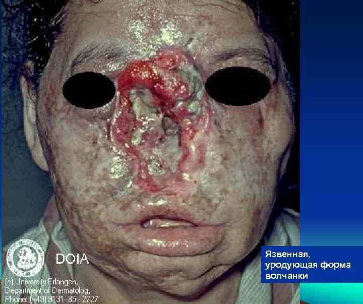 Язвенная, уродующая форма волчанки 