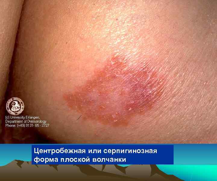 Центробежная или серпигинозная форма плоской волчанки 