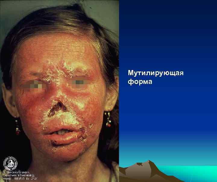 Мутилирующая форма 