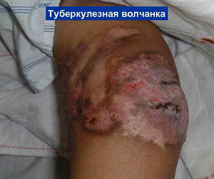 Туберкулезная волчанка 